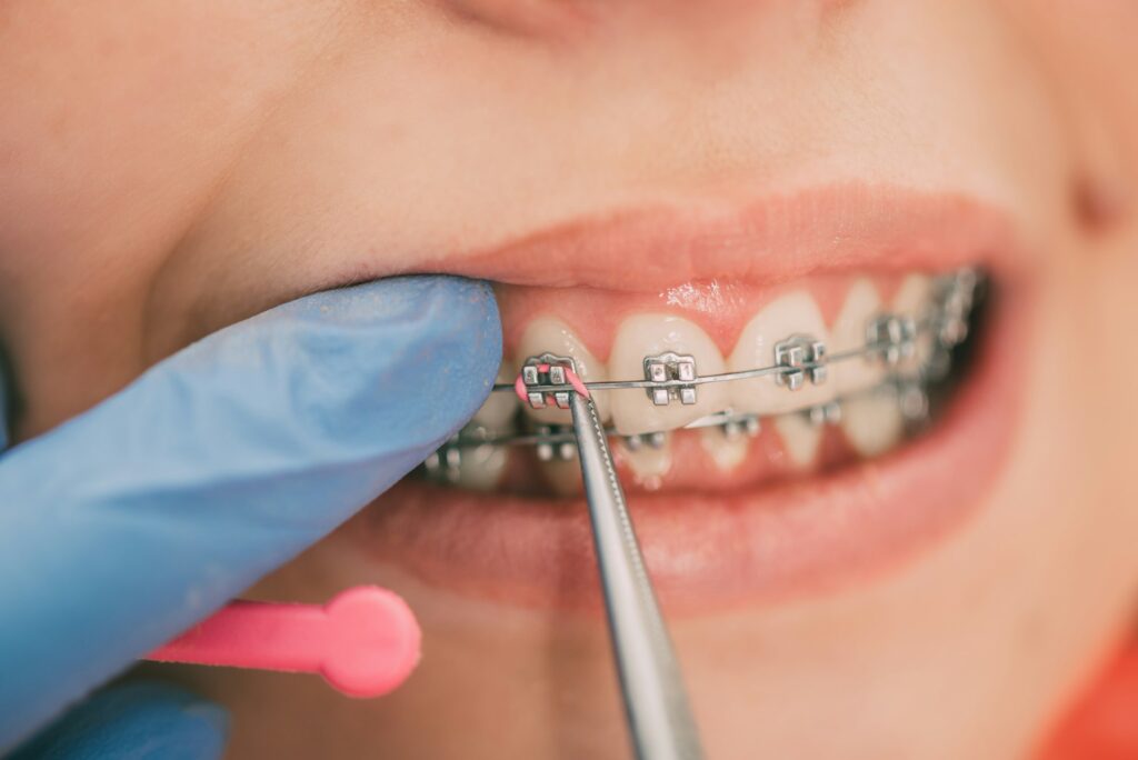 braces-1024x684