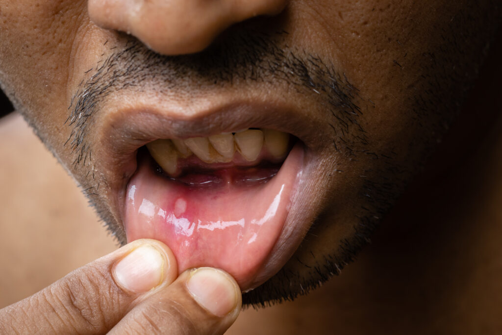 Painful mouth ulcer