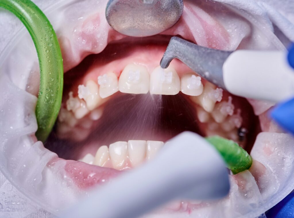 doctor-doing-professional-teeth-cleaning-in-dental-clinic-1024x759