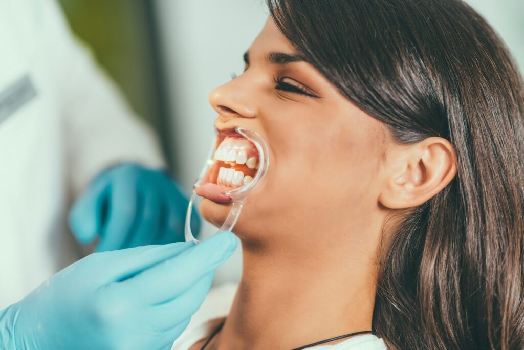 tooth-whitening-procedure-1024x684